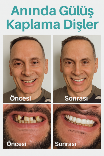 SnapSmile Pro™- Diş Kaplama Tak Çıkar Diş Beyazlatıcı Takma Diş